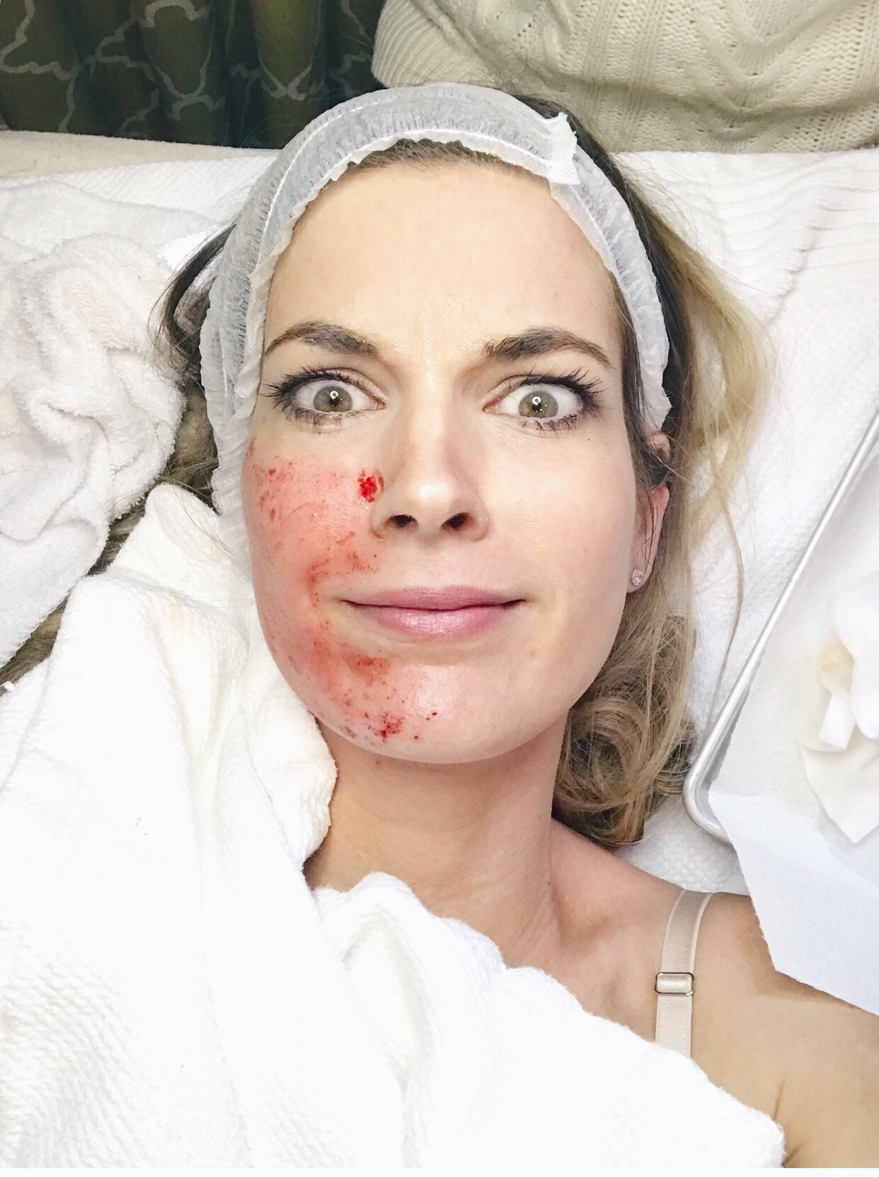 vampire facial review on pinteresting plans fashion blog